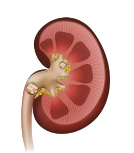 Prevention of Kidney Stone