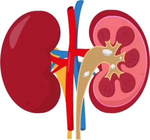 Kidney-Stone
