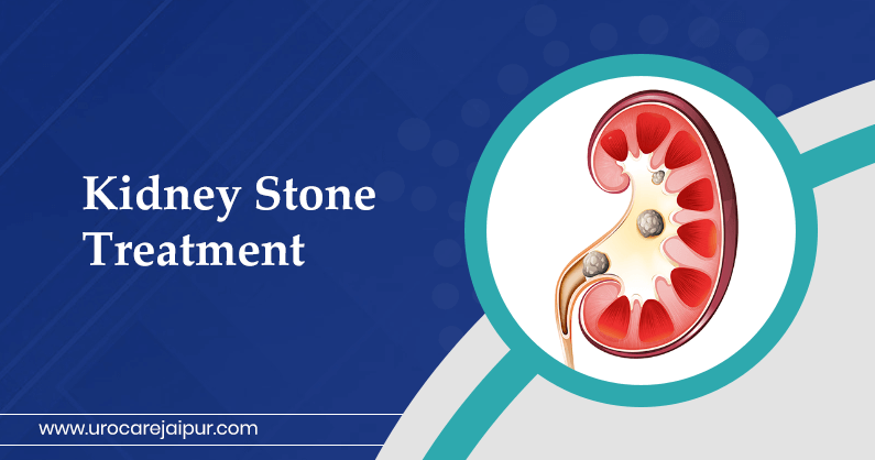 kidney-stone-treatment-in-Jaipur