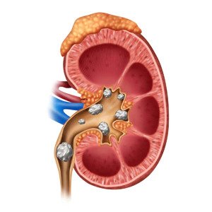 kidney_stones_square